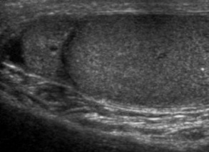 File:Ultrasonography of a normal epididymal head.jpg