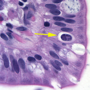 Cystoisospora belli oocyst in epithelial cell (hematoxylin and eosin).jpg