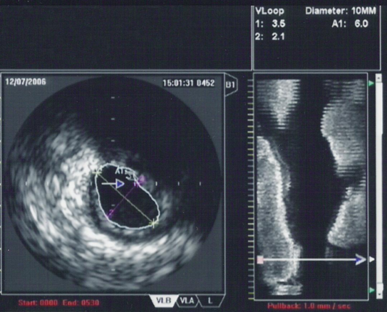 File:IVUS-Tracing.png