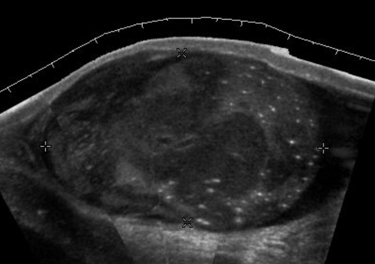 File:Scrotal ultrasonography of primary lymphoma.jpg