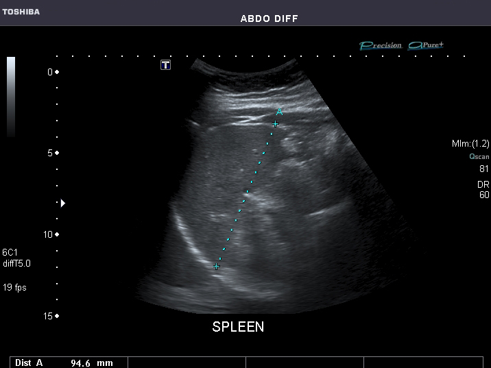 File:Abdominal Ultrasound Full Exam 52.jpg