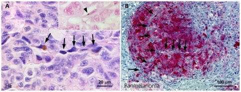 File:Vascular mimicry melanoma staining.jpg
