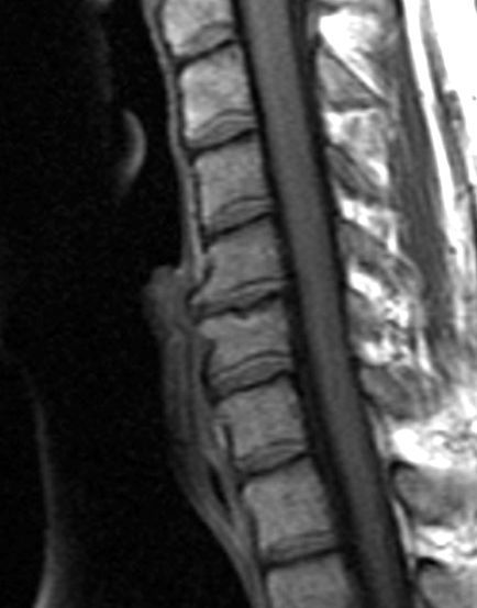 File:Cervical Spine MRI showing degenerative changes closeup.jpg
