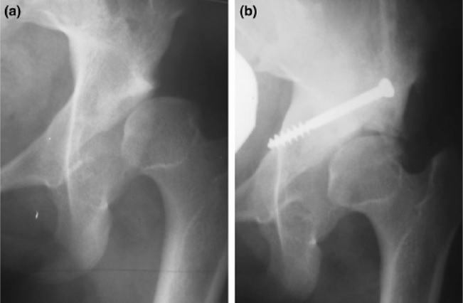 File:X-ray of the hip after (a) open reduction, capsulorrhaphy and Dega and (b) Chiari surgery.jpg