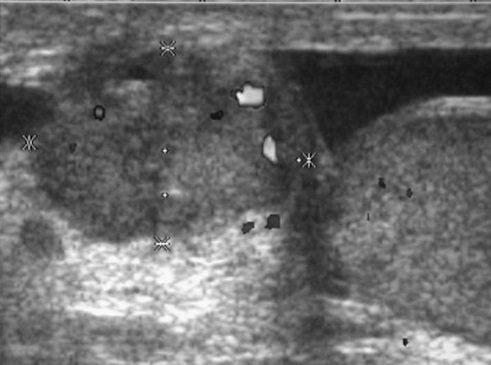 File:Scrotal ultrasonography of mesothelioma.jpg