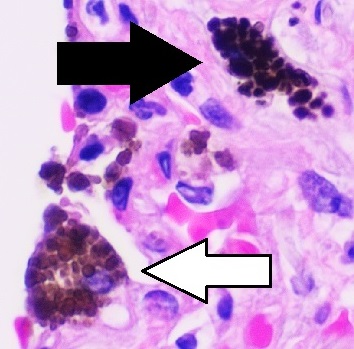 File:Histopathology of anthracotic macrophage in lung, annotated.jpg