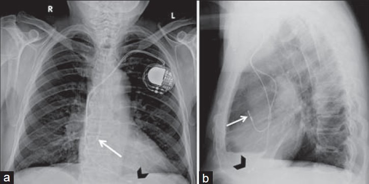 File:X-ray of pacemaker with right atrial and ventricular lead.jpg
