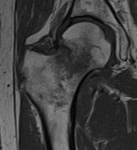 File:T1 TSE MRI of hip fracture.jpg