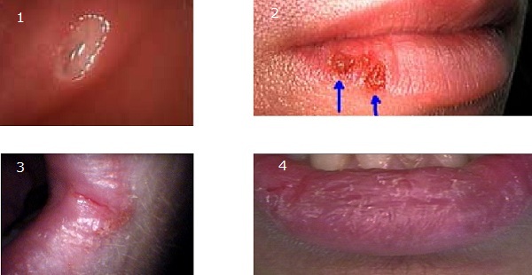 File:Photographic Comparison of a Canker Sore, Herpes, Angular Cheilitis and Chapped Lips..jpg