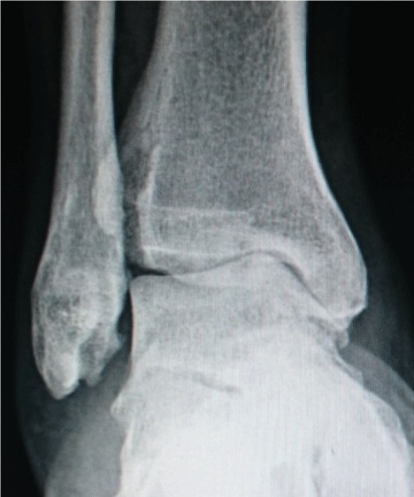 File:X-ray of ankle osteoarthritis.jpg