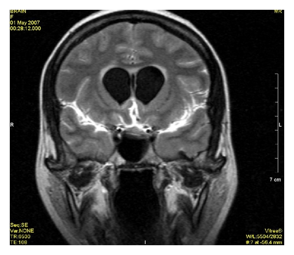 File:FLAIR MRI of meningitis.jpg
