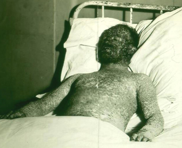 File:Hemorrhagic smallpox 2 (cropped).jpg