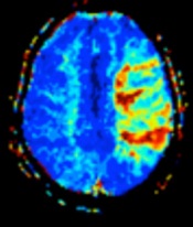 File:Tmax by MRI perfusion in cerebral artery occlusion.jpg