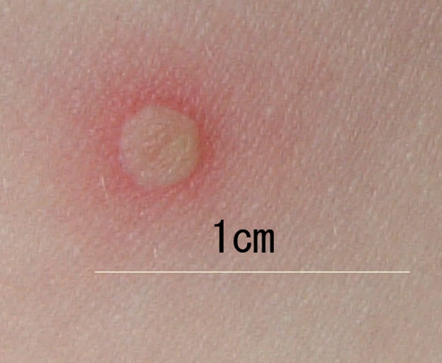 File:Chickenpox blister-(closeup).jpg