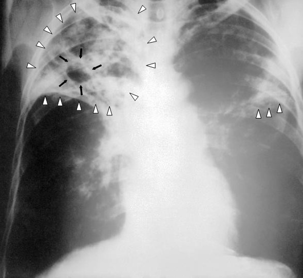 File:Tuberculosis-x-ray-1.jpg