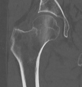File:CT of subtle compressive hip fracture.jpg