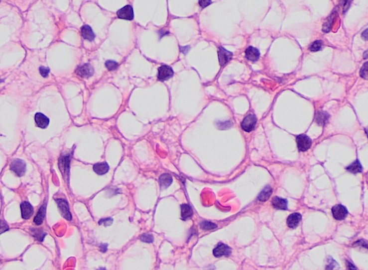 File:Histopathology of clear cell renal cell carcinoma, grade 1, high magnification.jpg