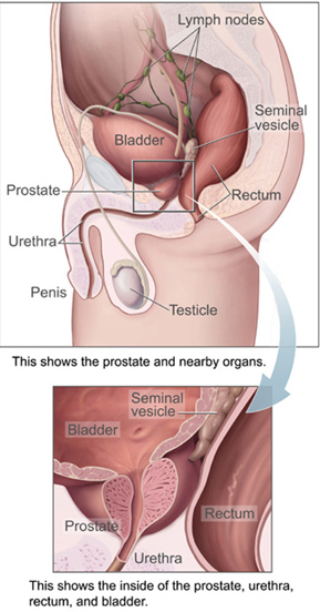 File:Prostatelead.jpg