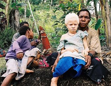 File:Albinistic girl papua new guinea.jpg
