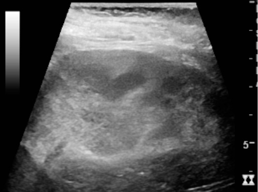 File:Ultrasonography of acute pyelonephritis.jpg