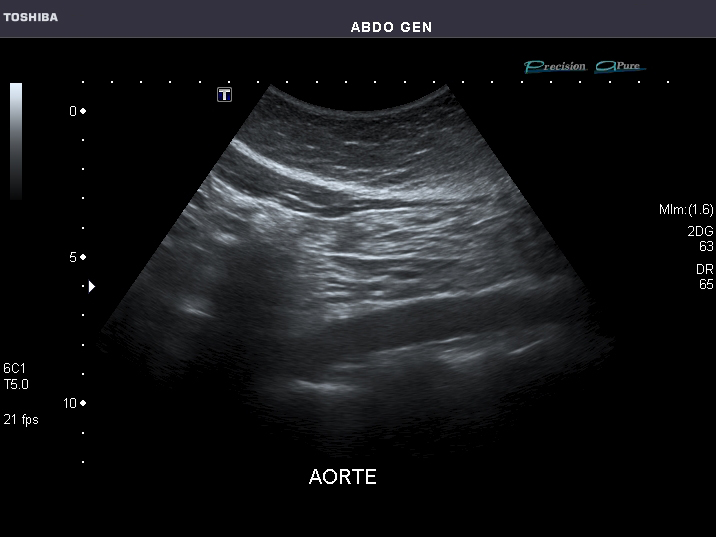 File:Abdominal Ultrasound Full Exam 47.jpg