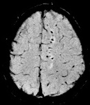 File:Susceptibility weighted imaging (SWI) in diffuse axonal injury.jpg