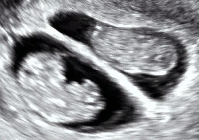 File:Dichorionic twins with heart activity at 8w5d since co-incubation.gif