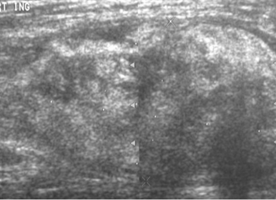 File:Scrotal ultrasonography of liposarcoma.jpg