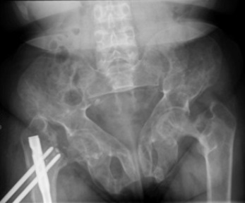 File:X-ray of brown tumors in the pelvis and a hip fracture in renal osteodystrophy.jpg