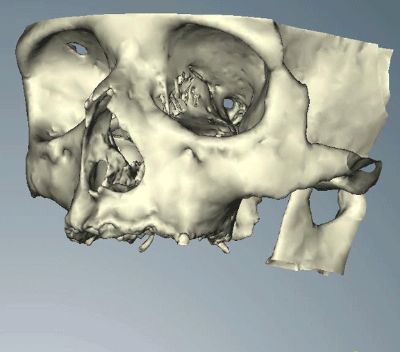 File:CT CADCAM IMPLANTPLACEMENT.gif