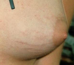 File:Stretch marks on female breast.jpg