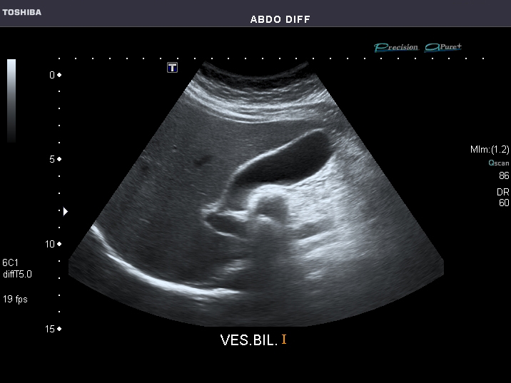 File:Abdominal Ultrasound Full Exam 15.jpg