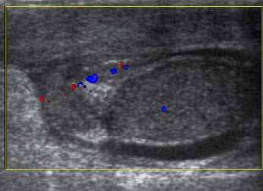 File:Scrotal ultrasonography of testicular appendiceal torsion.jpg