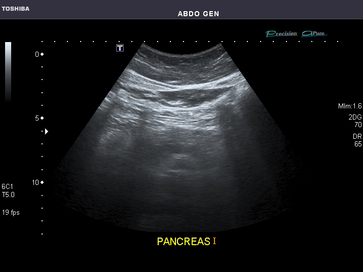 File:Abdominal Ultrasound Full Exam 37.jpg