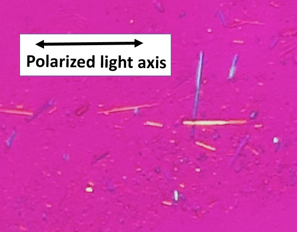 File:Birefringence microscopy of gout, annotated.jpg