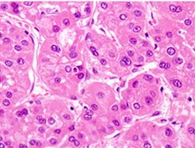 File:Histopathology of moderately differentiated hepatocellular carcinoma.jpg