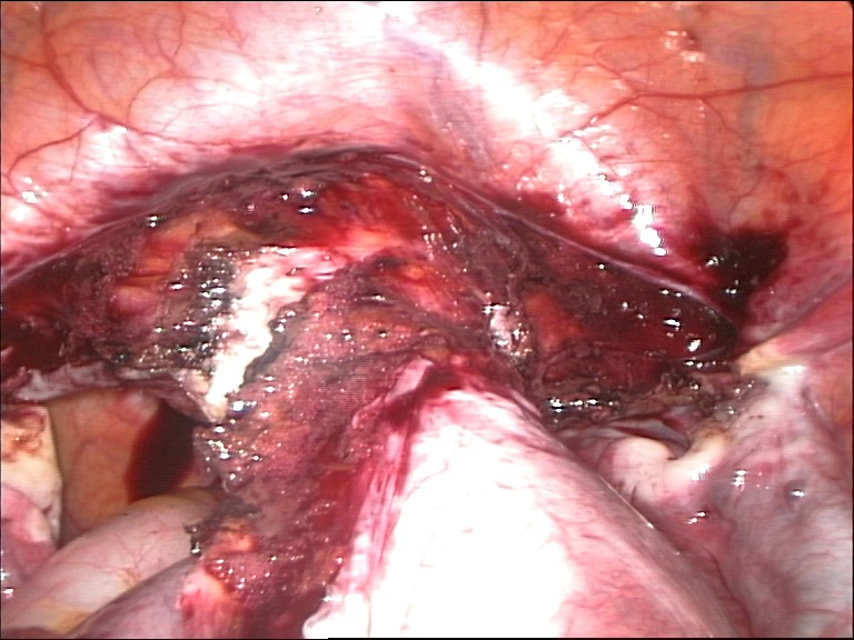 File:Hysterectomy2.jpg