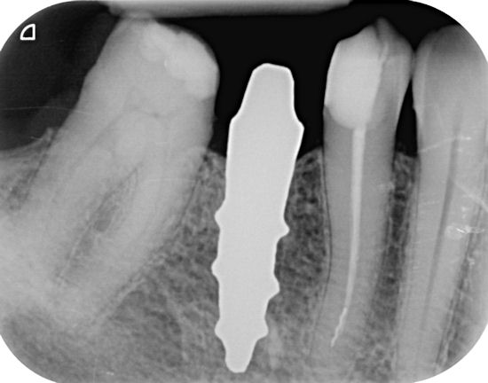 File:X-ray of root analogue dental implant single rooted right lower second premolar.jpg