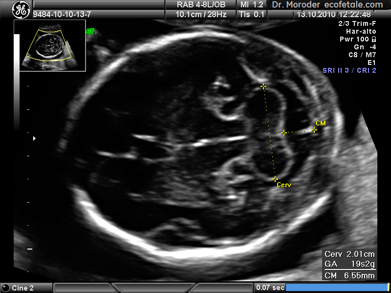 File:Cervelletto e cisterna magna ecografia ad ultrasuoni Dr. Wolfgang Moroder.jpg
