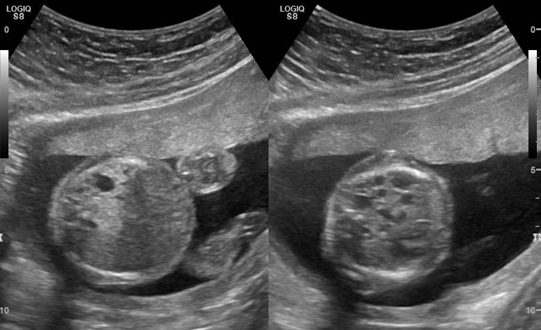 File:Congenital pulmonary airway malformation in a fetus.jpg