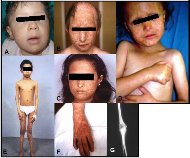 File:Rothmund-Thomson syndrome.jpg