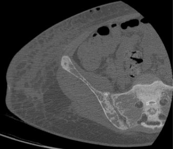 File:CT of subchondral resorption in the SI joint in renal osteodystrophy.jpg
