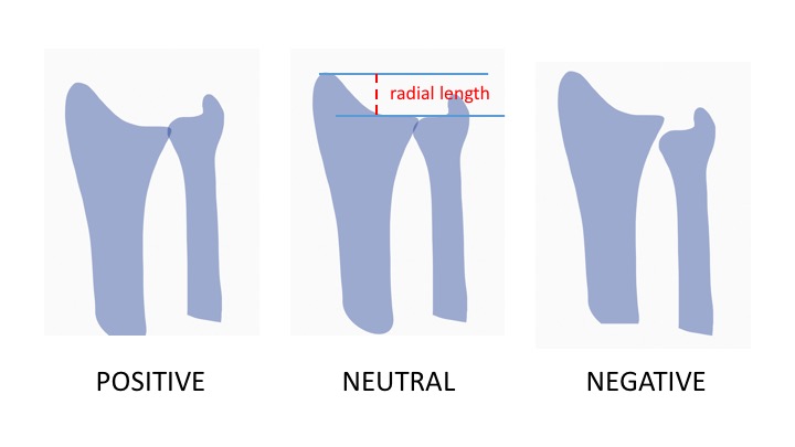 File:Radial length and ulnar variance.jpg