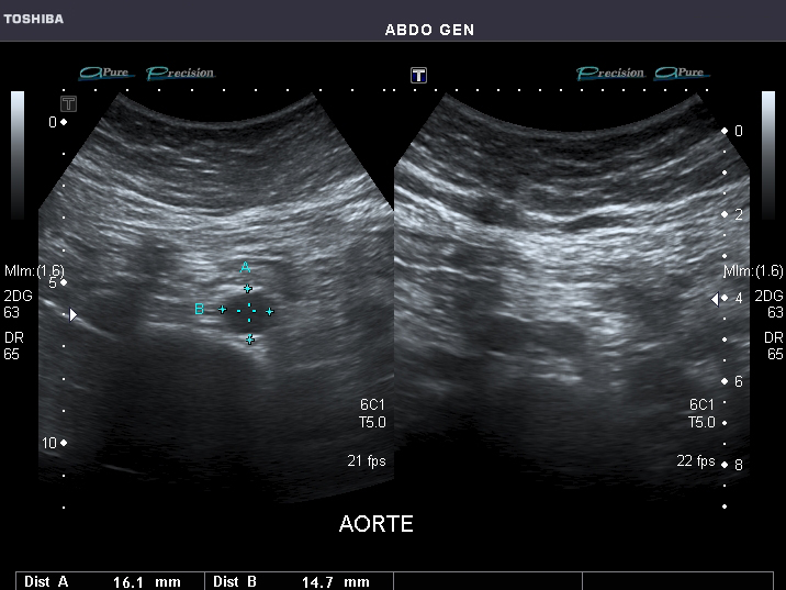 File:Abdominal Ultrasound Full Exam 43.jpg