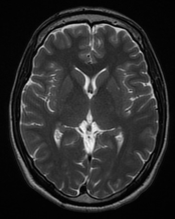 File:Normal axial T2-weighted MR image of the brain.jpg