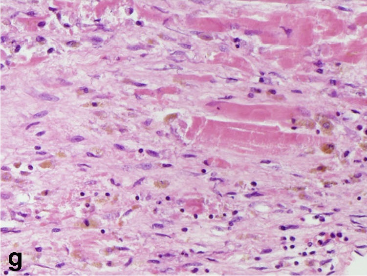 File:Histopathology of fibroblast proliferation and early collagen deposition in myocardial infarction.jpg
