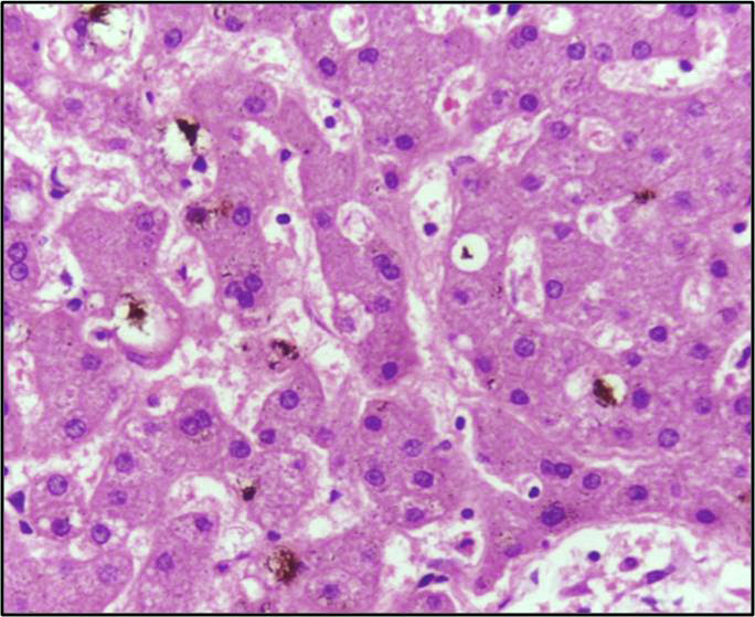 File:Bilirubin pigment in cholestatic liver 40X.jpg