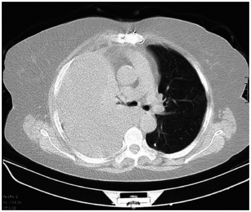 File:CT scan showing hemothorax caused by warfarin use.png