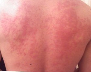 Hives on back.jpg