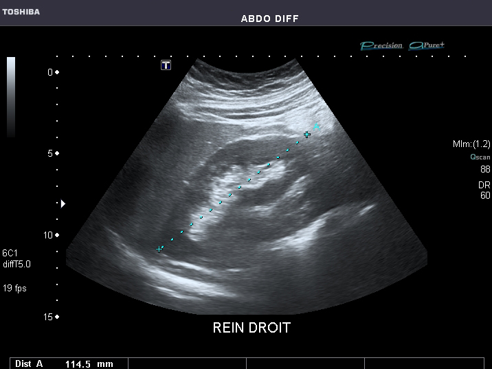 File:Abdominal Ultrasound Full Exam 27.jpg